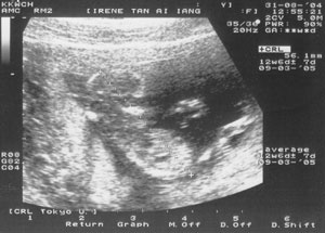 Ultrasound at 12 weeks