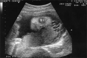 Ultrasound at 5 months
